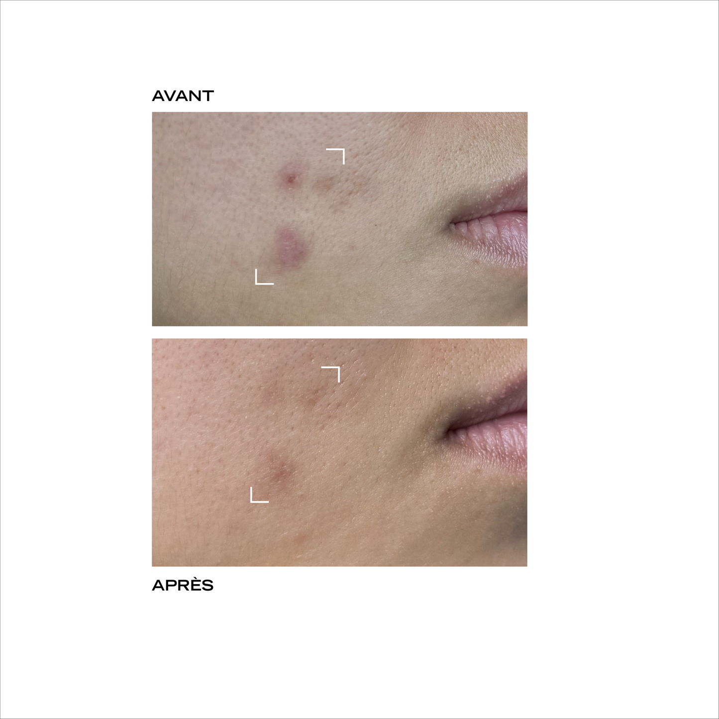 Serum Peeling FR